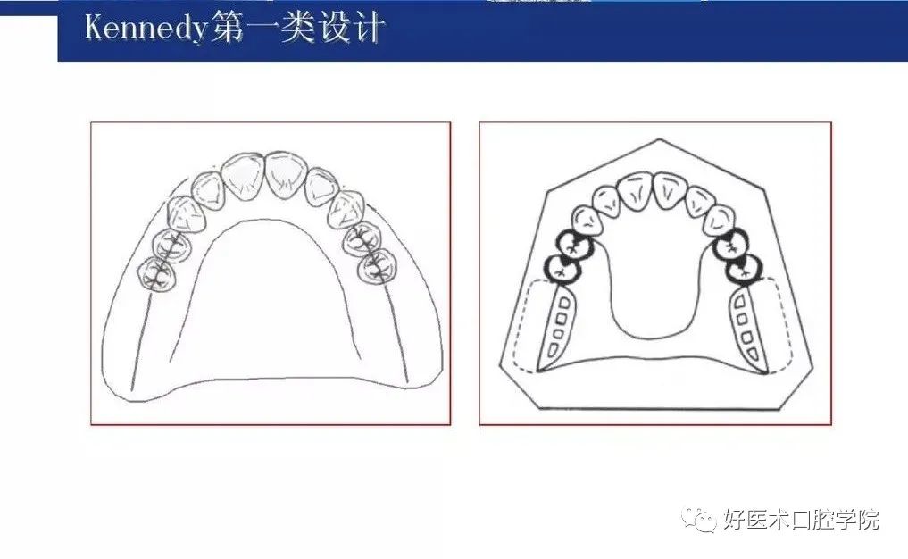 牙列缺损该如何设计修复，一文带你看懂！