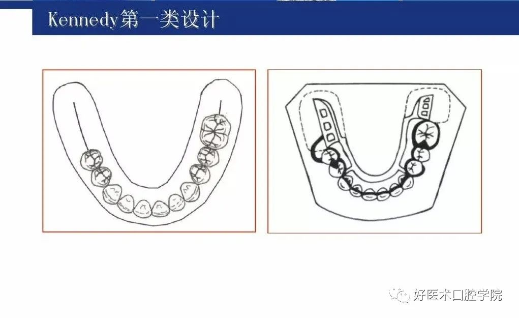 牙列缺损该如何设计修复，一文带你看懂！