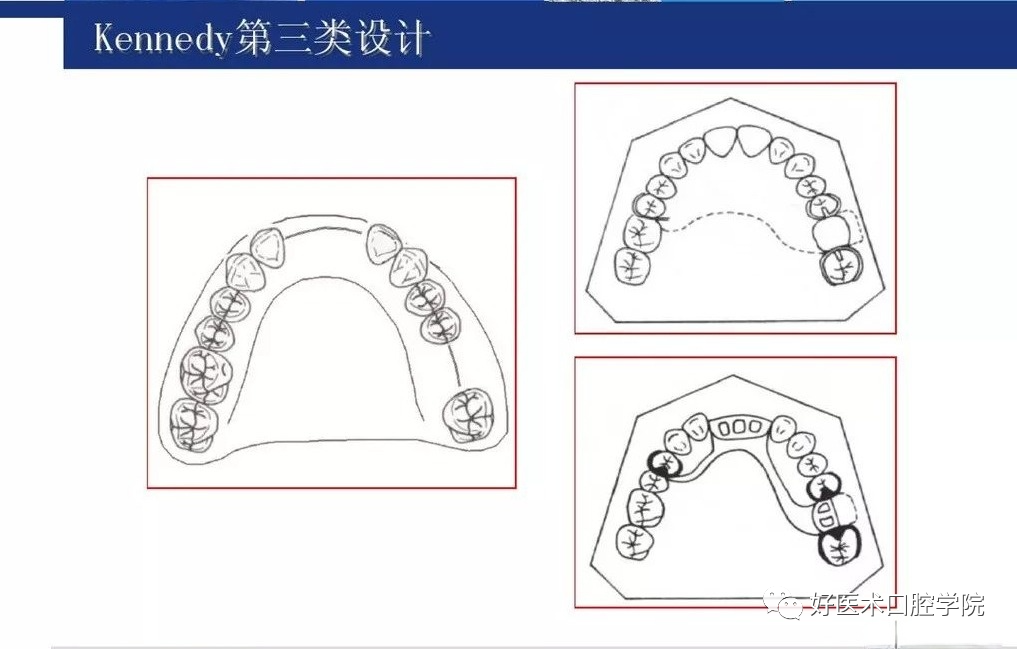 牙列缺损该如何设计修复，一文带你看懂！