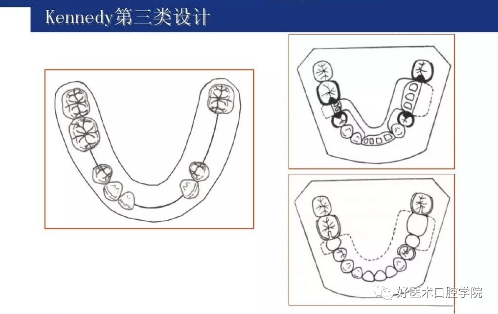 牙列缺损该如何设计修复，一文带你看懂！