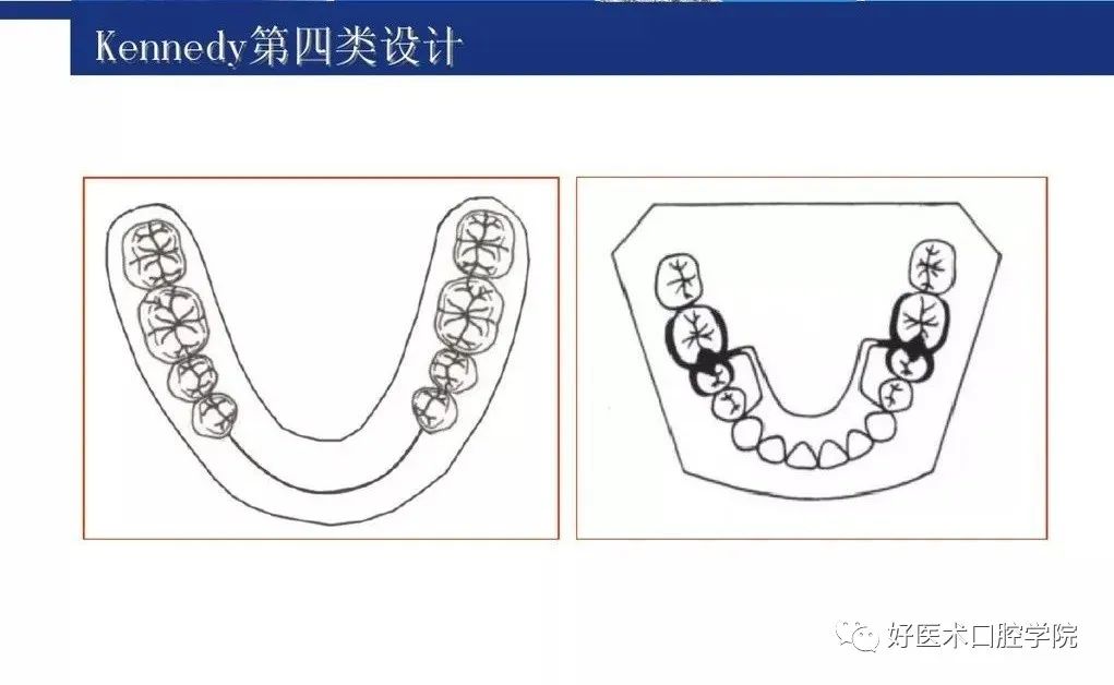 牙列缺损该如何设计修复，一文带你看懂！