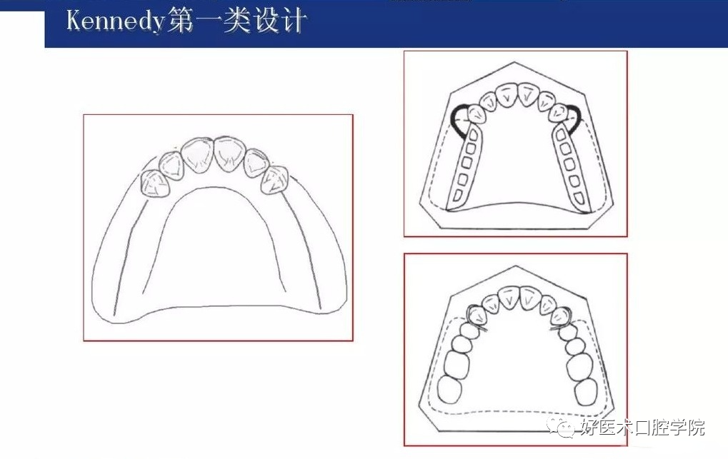 牙列缺损该如何设计修复，一文带你看懂！