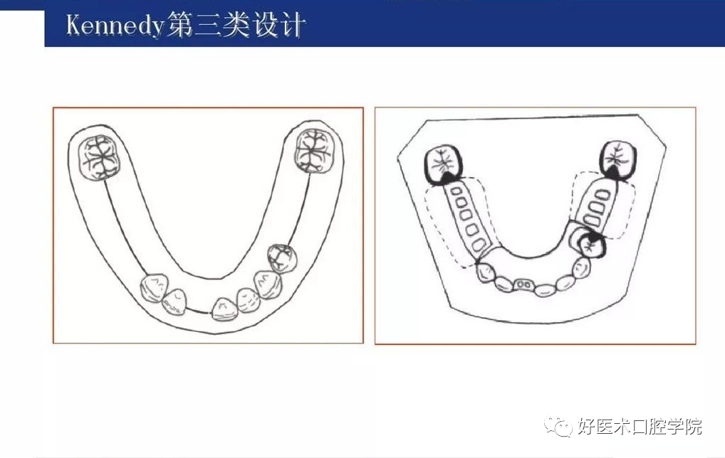 牙列缺损该如何设计修复，一文带你看懂！