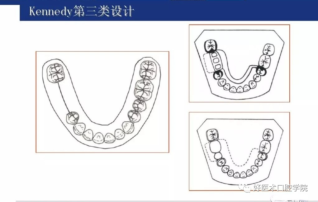 牙列缺损该如何设计修复，一文带你看懂！