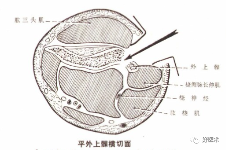 做好桡骨头骨折钢板内固定，10个细节必须到位！