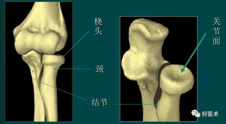 做好桡骨头骨折钢板内固定，10个细节必须到位！