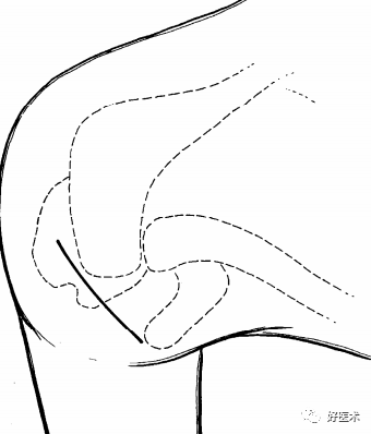8个细节操作步骤，掌握肩袖小切口修补技术！