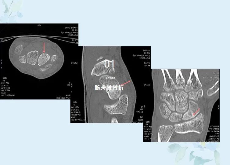 腕关节病变MRI如何诊断？高清图文解析帮你搞定！