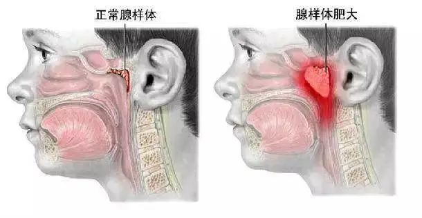 别让口呼吸毁了孩子的颜值！正畸医生告诉你怎么办！