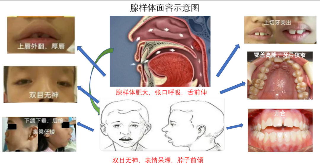 别让口呼吸毁了孩子的颜值！正畸医生告诉你怎么办！