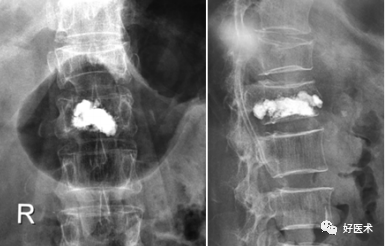 骨水泥什么时候打、打多少、怎么打？这篇文章解决你95%的困惑！