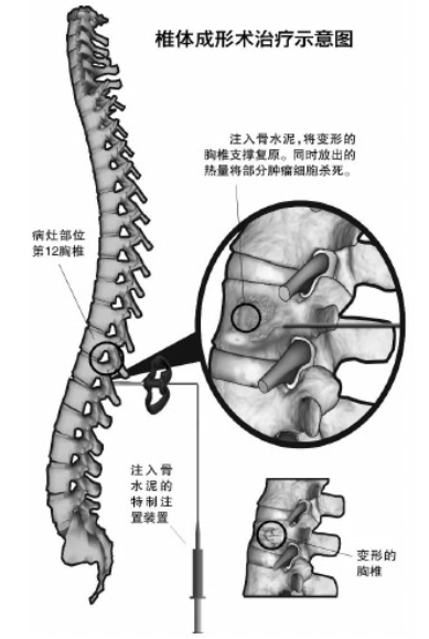 骨水泥什么时候打、打多少、怎么打？这篇文章解决你95%的困惑！