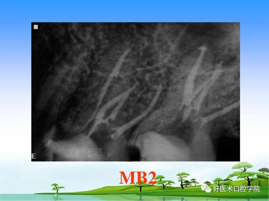 综合总结开髓技术与操作要点，看这一篇就够了！