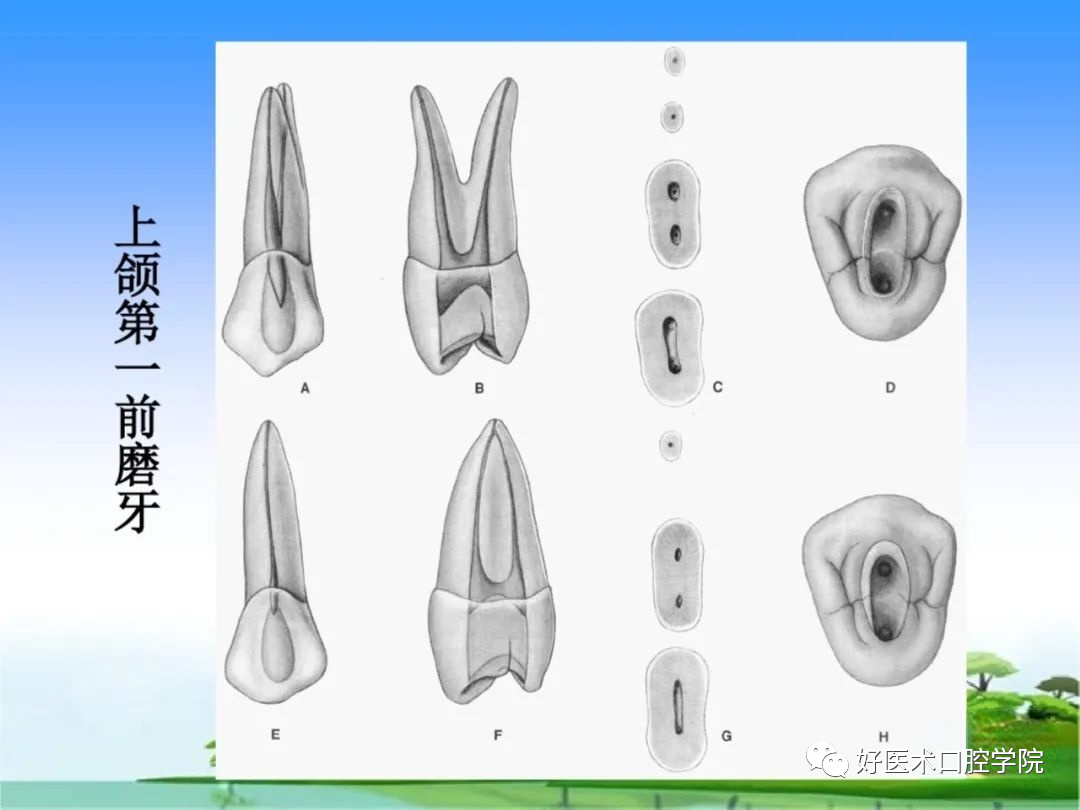 综合总结开髓技术与操作要点，看这一篇就够了！