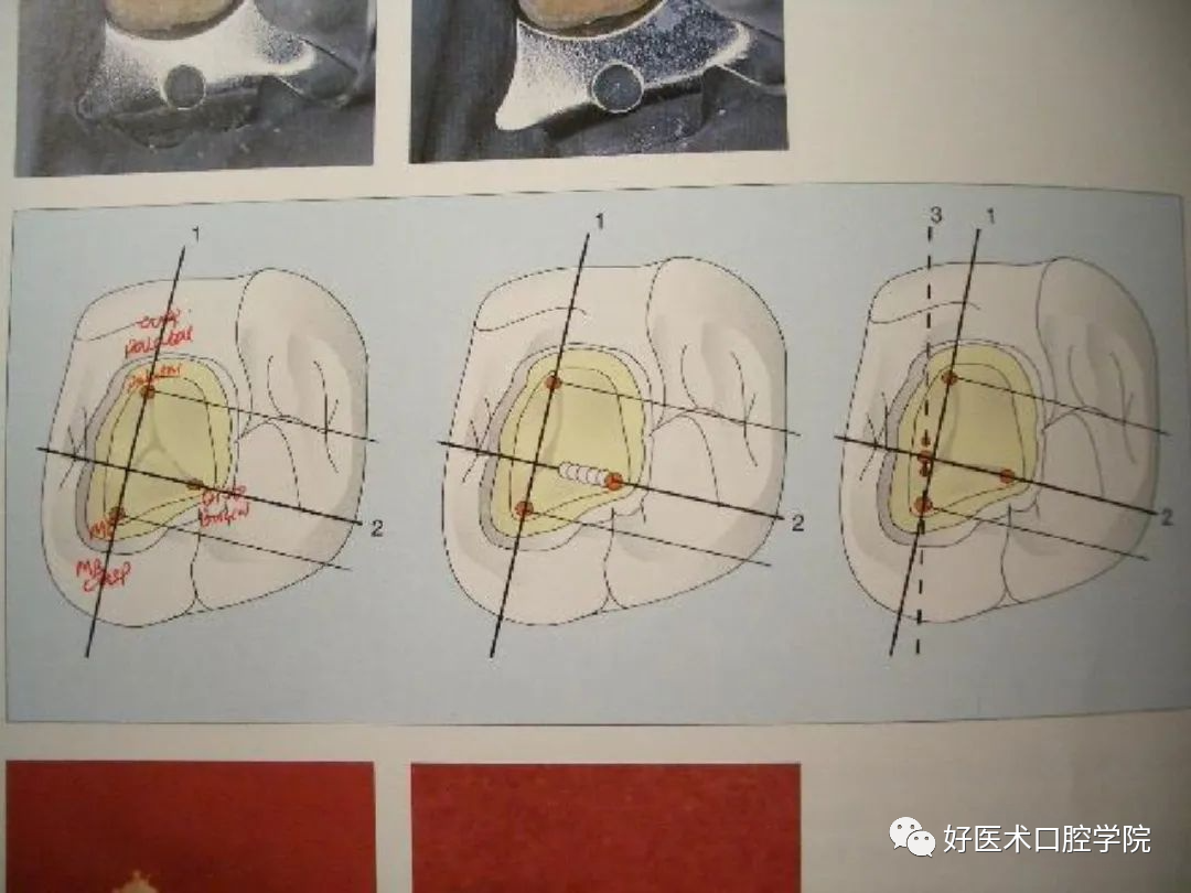 综合总结开髓技术与操作要点，看这一篇就够了！