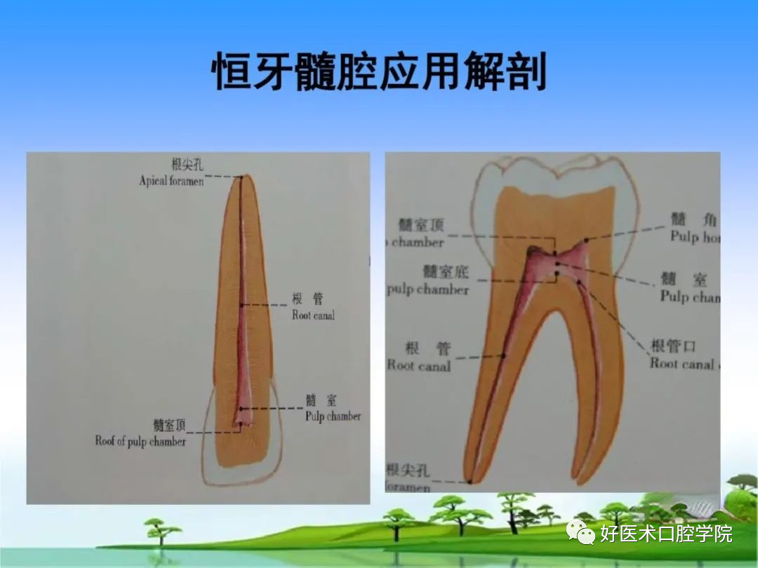 综合总结开髓技术与操作要点，看这一篇就够了！