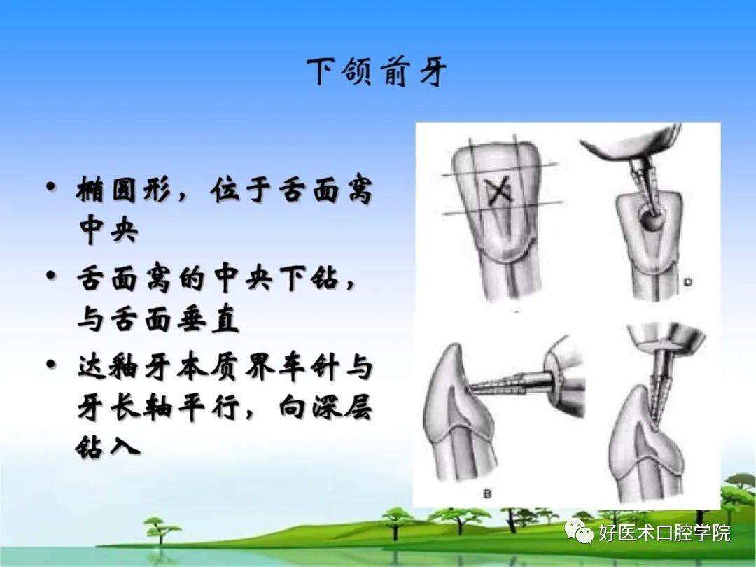 综合总结开髓技术与操作要点，看这一篇就够了！