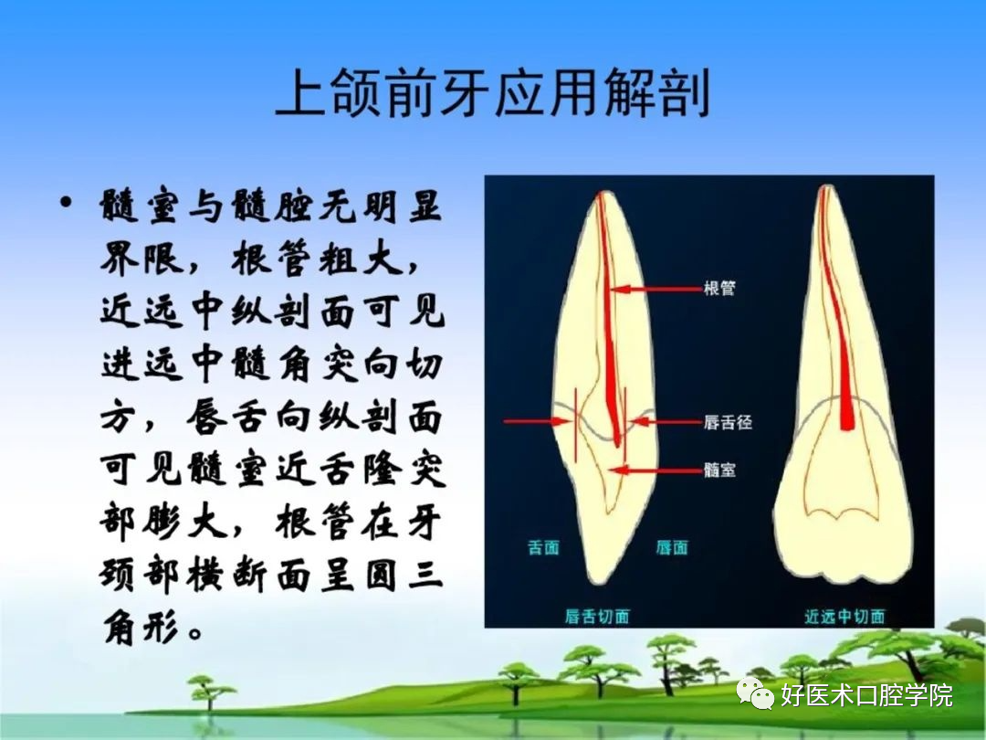 综合总结开髓技术与操作要点，看这一篇就够了！