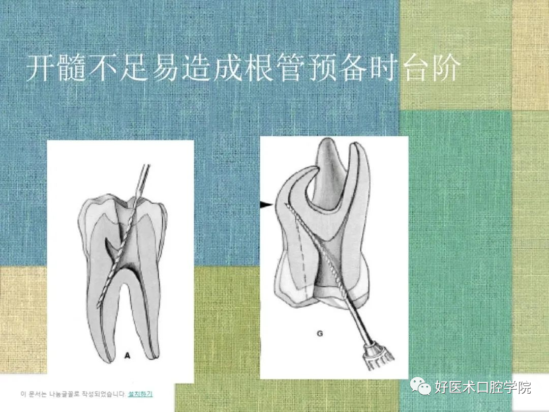 综合总结开髓技术与操作要点，看这一篇就够了！