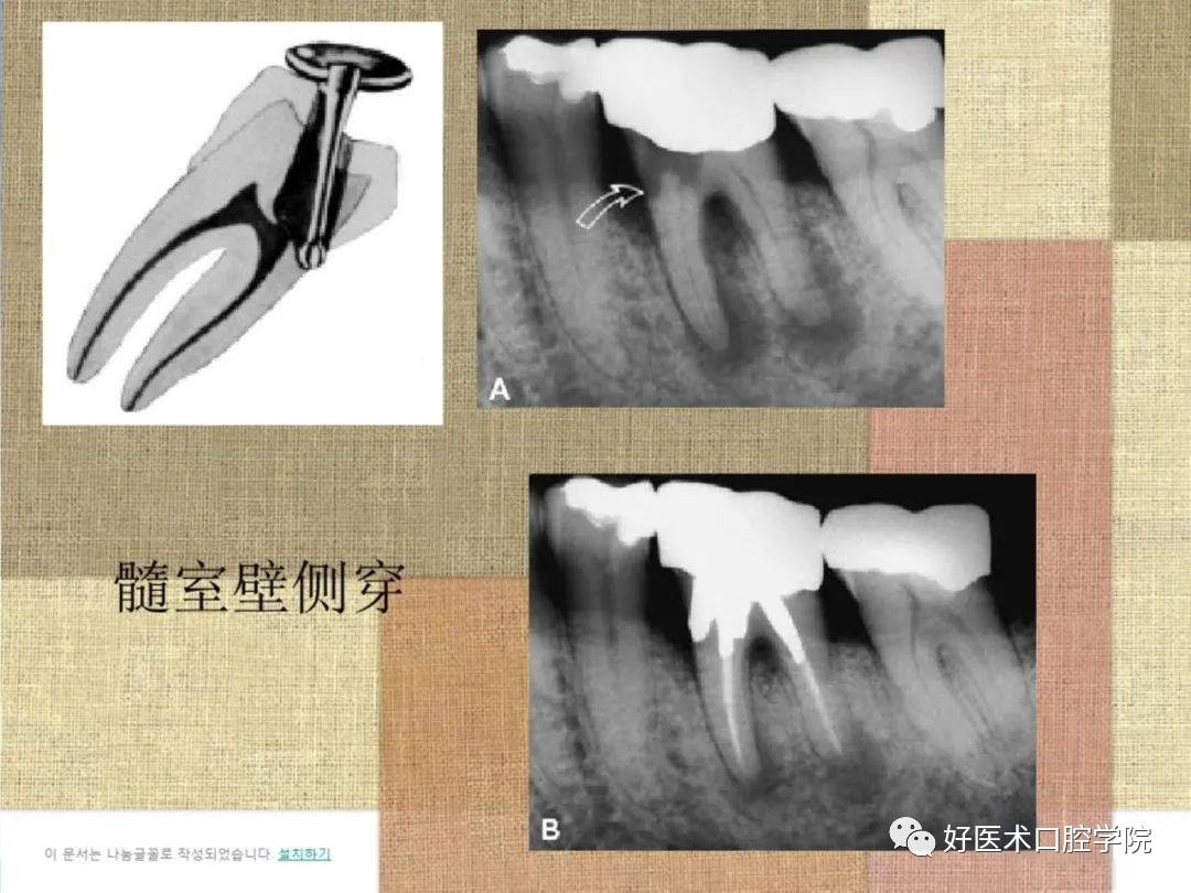 综合总结开髓技术与操作要点，看这一篇就够了！