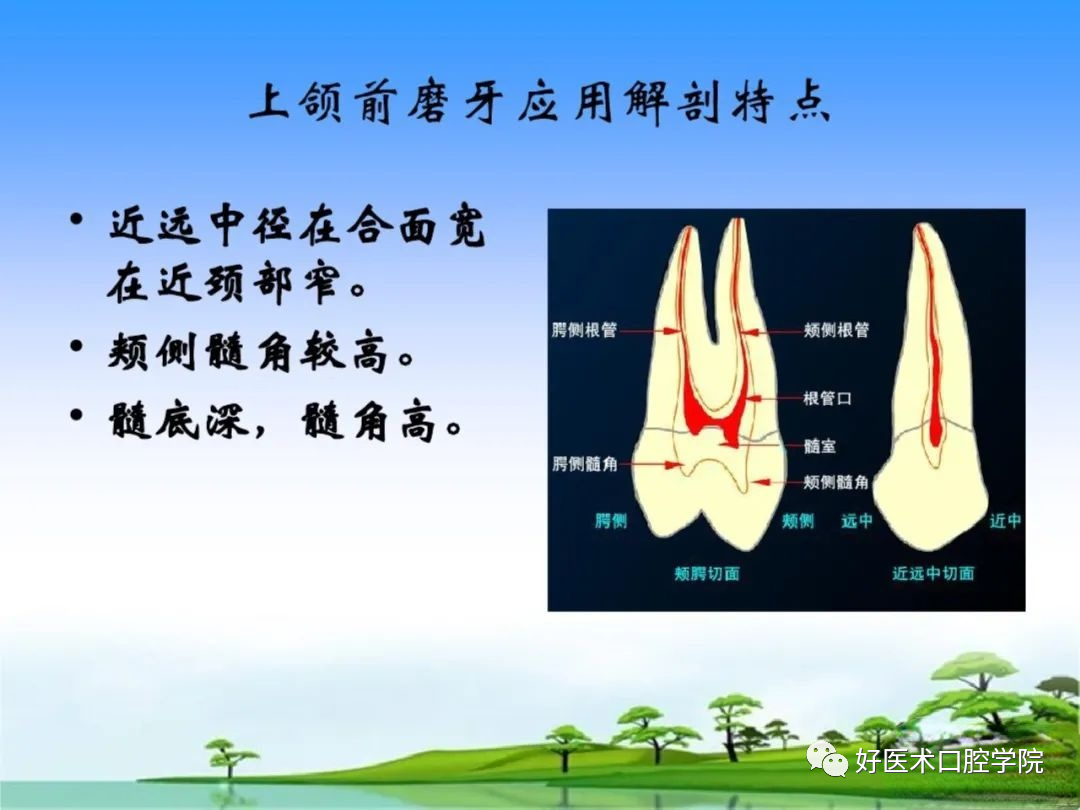 综合总结开髓技术与操作要点，看这一篇就够了！