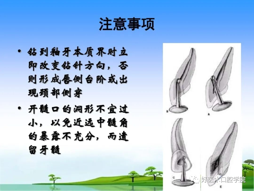 综合总结开髓技术与操作要点，看这一篇就够了！