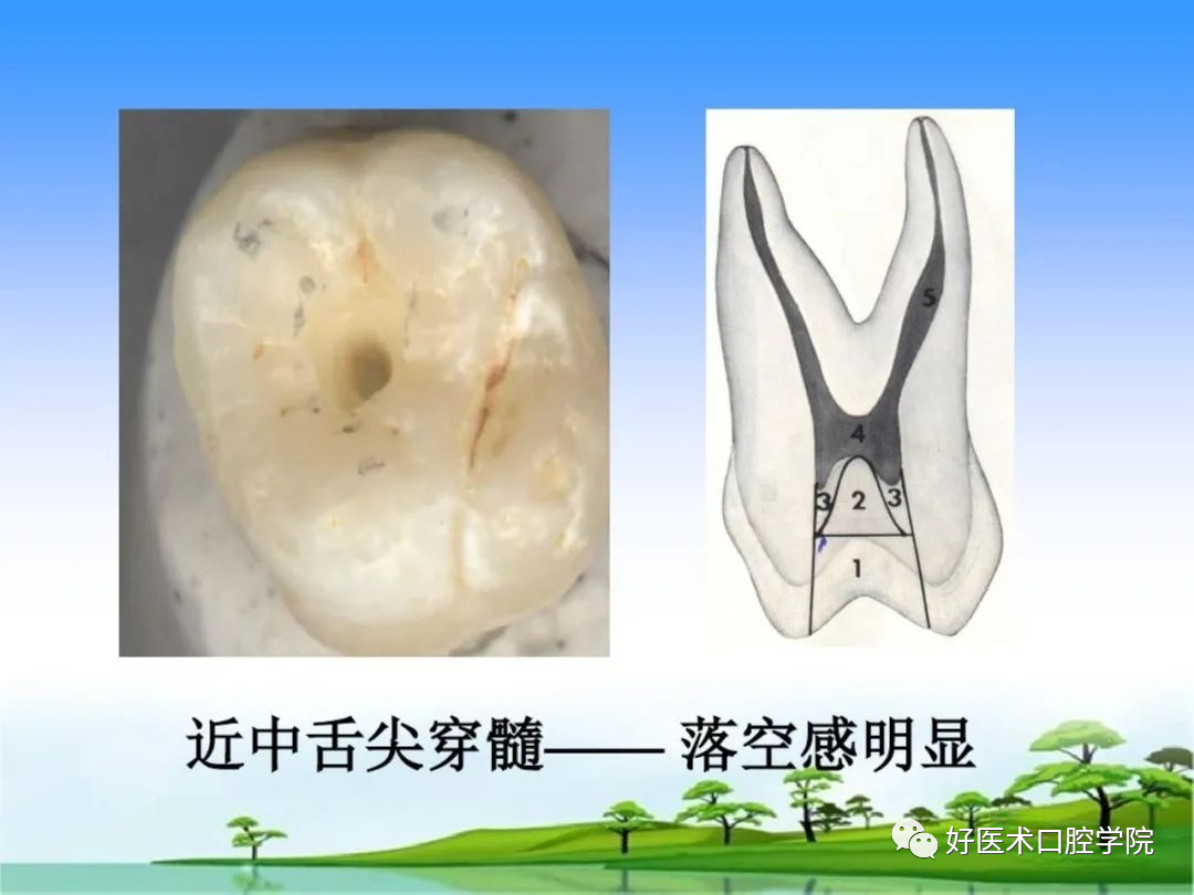 综合总结开髓技术与操作要点，看这一篇就够了！