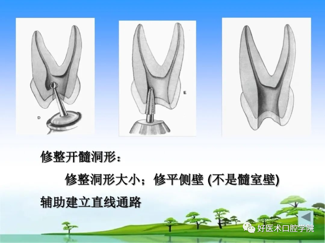 综合总结开髓技术与操作要点，看这一篇就够了！