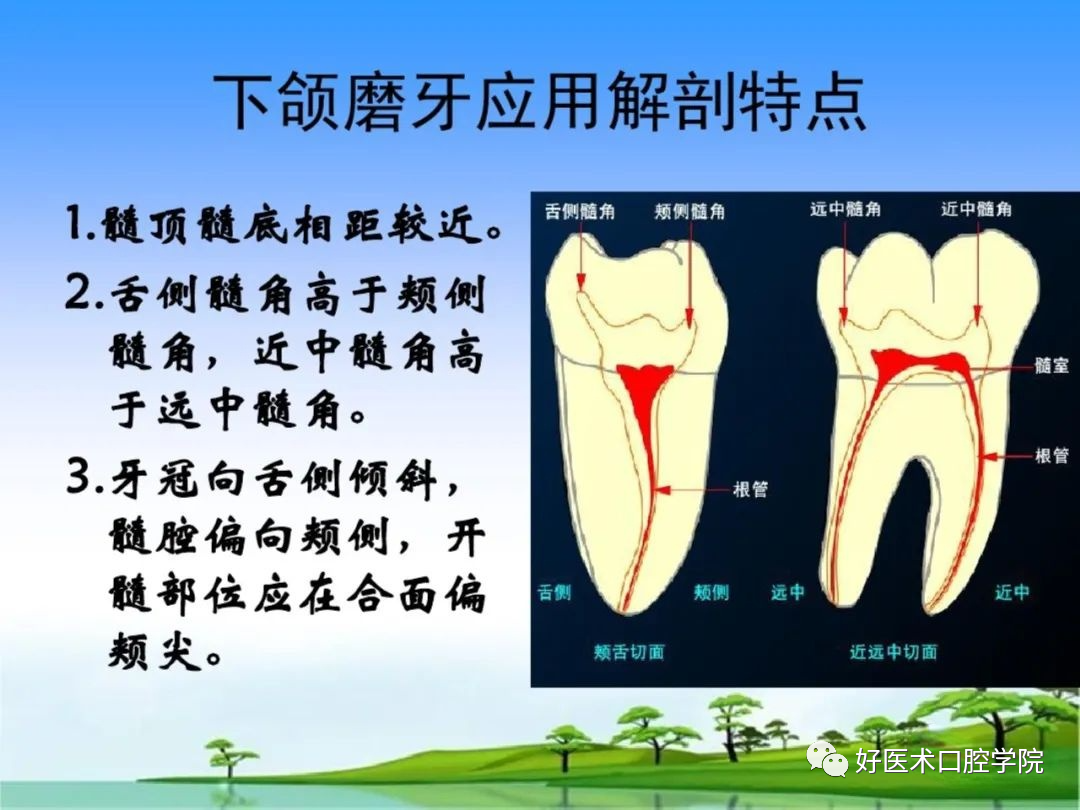 综合总结开髓技术与操作要点，看这一篇就够了！