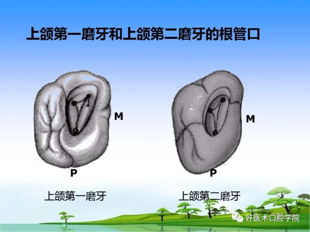 综合总结开髓技术与操作要点，看这一篇就够了！