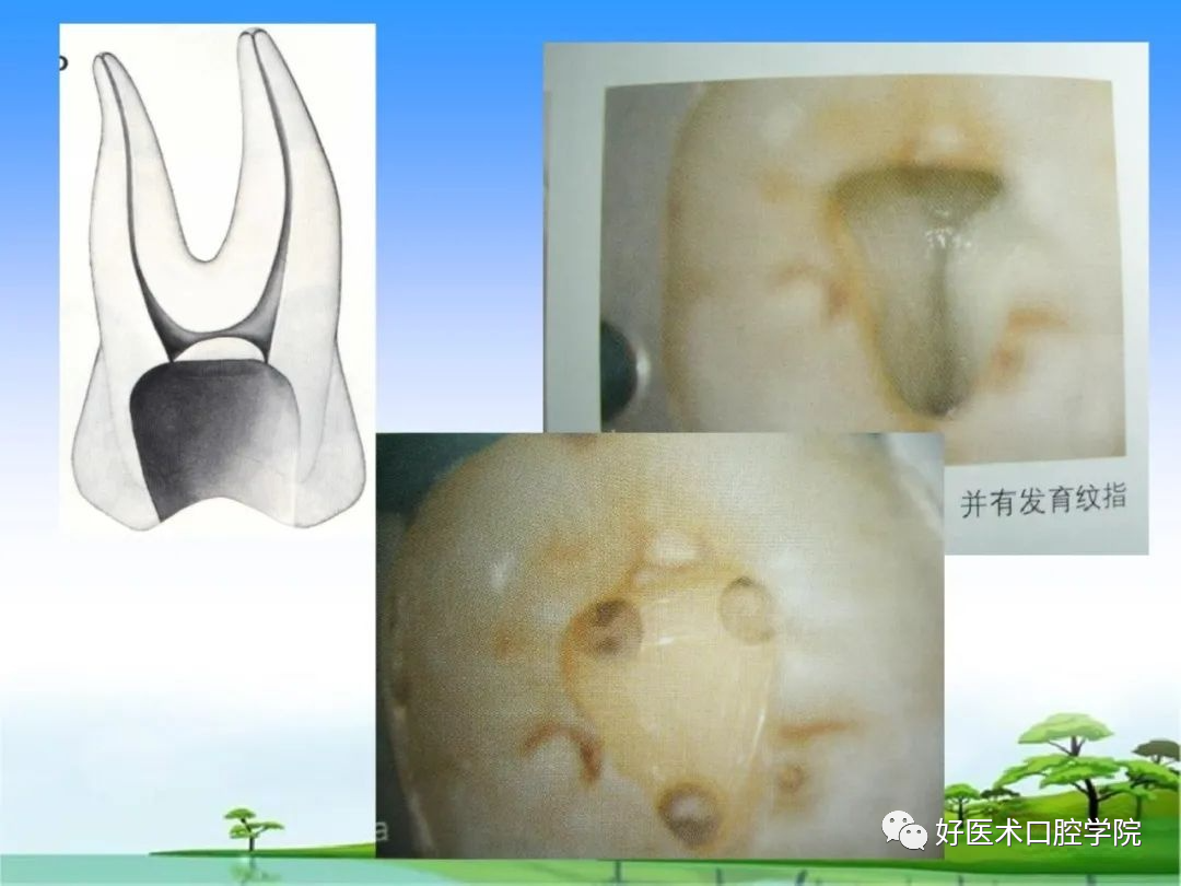 髓腔应用解剖 - 哔哩哔哩