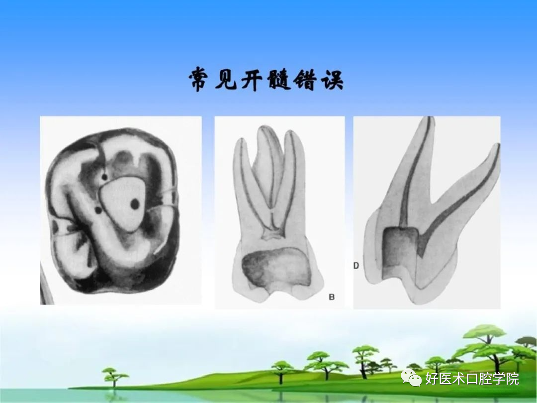 综合总结开髓技术与操作要点，看这一篇就够了！