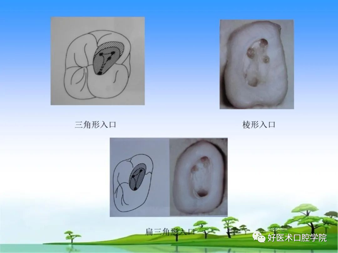 综合总结开髓技术与操作要点，看这一篇就够了！