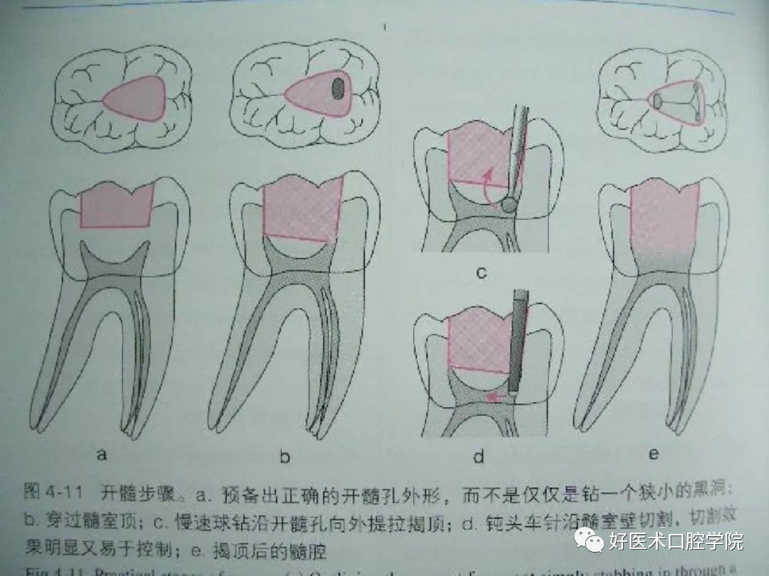 综合总结开髓技术与操作要点，看这一篇就够了！