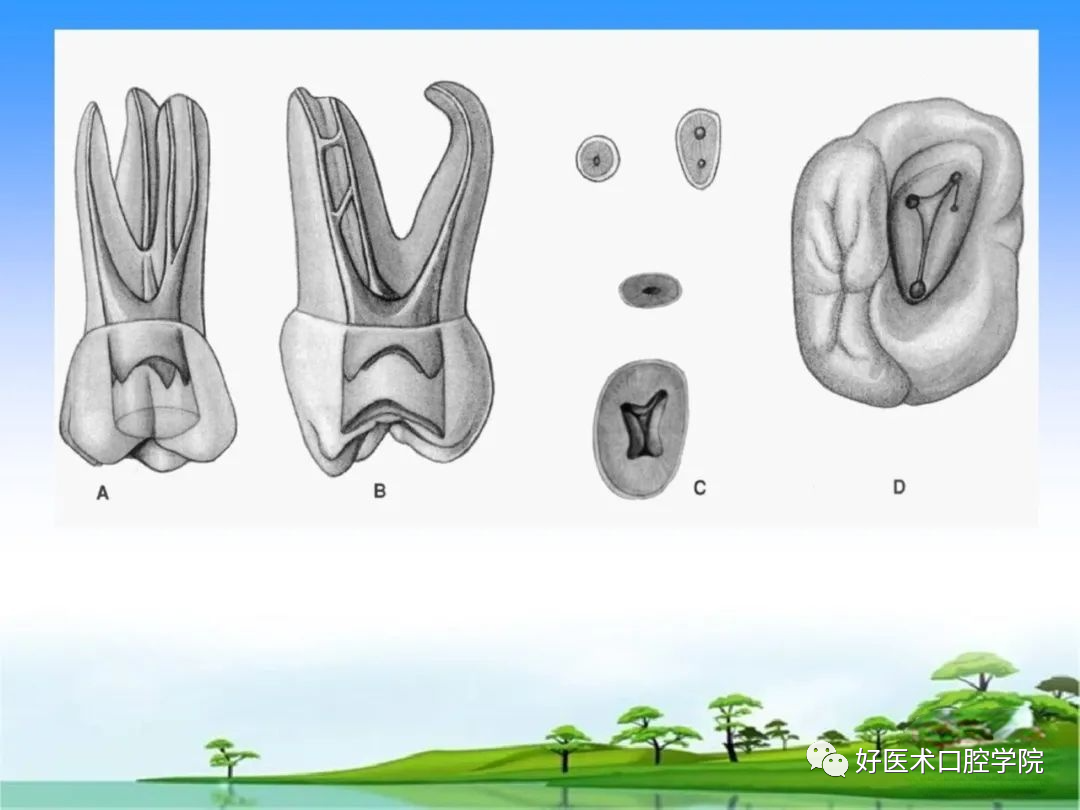 综合总结开髓技术与操作要点，看这一篇就够了！