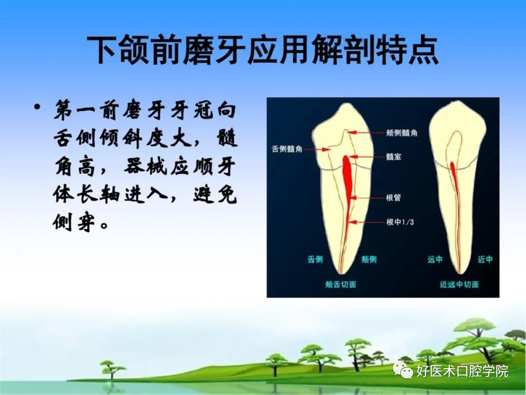 综合总结开髓技术与操作要点，看这一篇就够了！