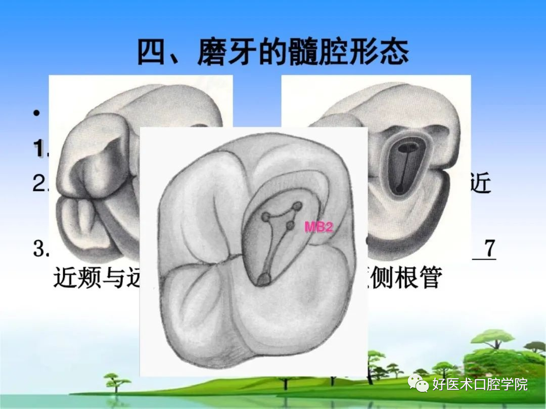 综合总结开髓技术与操作要点，看这一篇就够了！