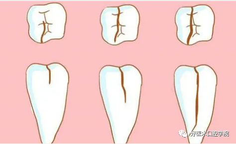 牙根纵裂的牙齿不易察觉，一文告诉你问题在哪！