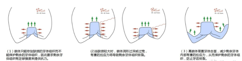 髓腔固位的临床应用，看看是不是你想知道的！