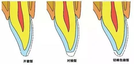 图文结合一步步教会你瓷贴面牙体预备方法，值得收藏！