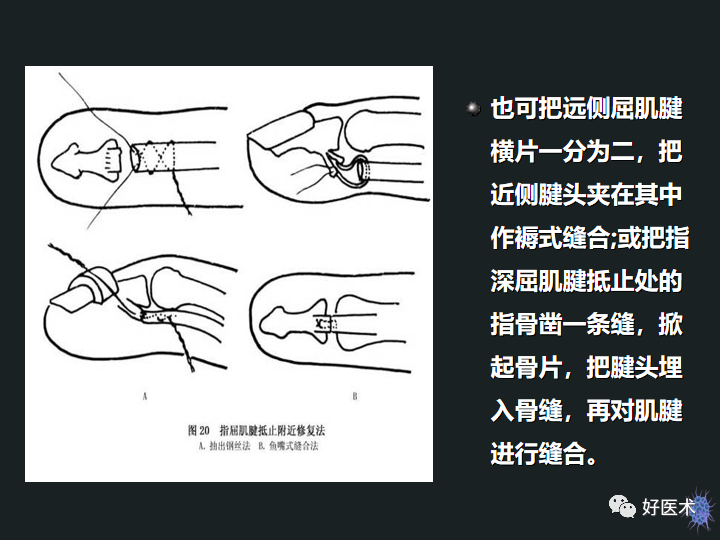 肌腱缝合图解图片