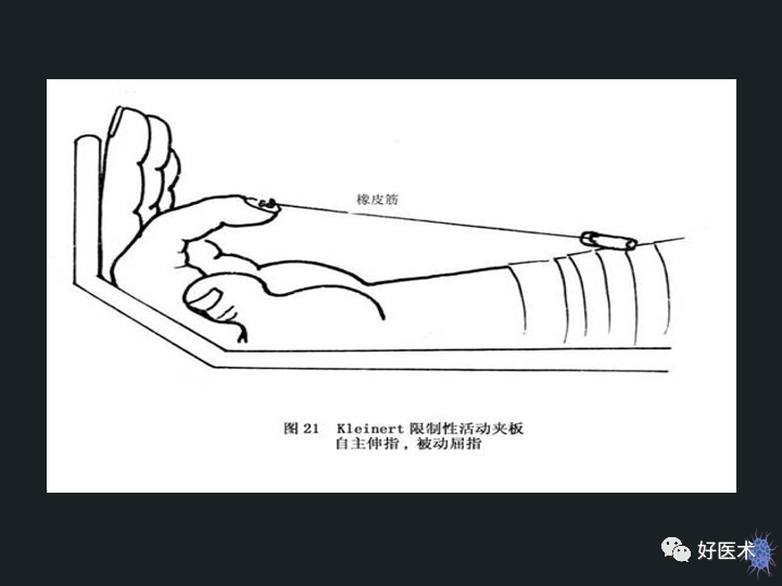 骨科必备技能肌腱缝合固定术，图文详解清晰明了！