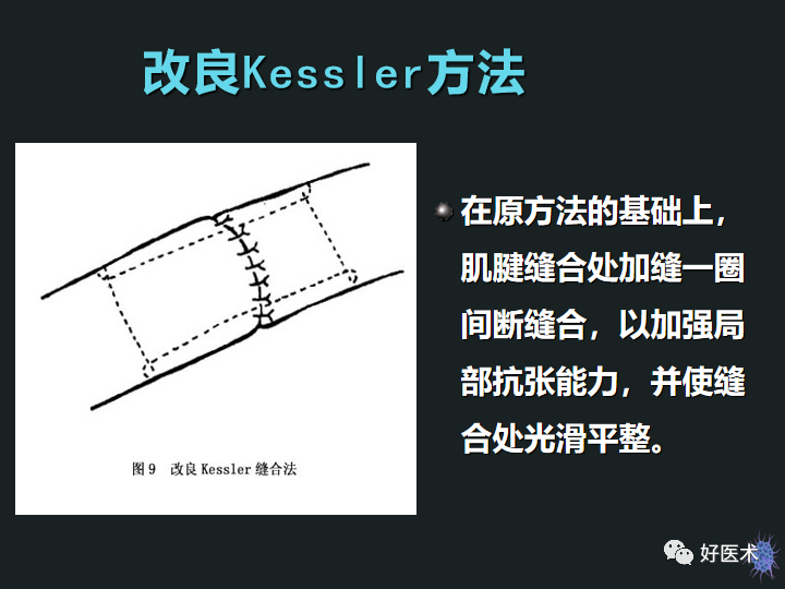 骨科必备技能肌腱缝合固定术，图文详解清晰明了！