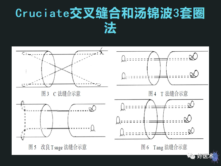 骨科必备技能肌腱缝合固定术，图文详解清晰明了！