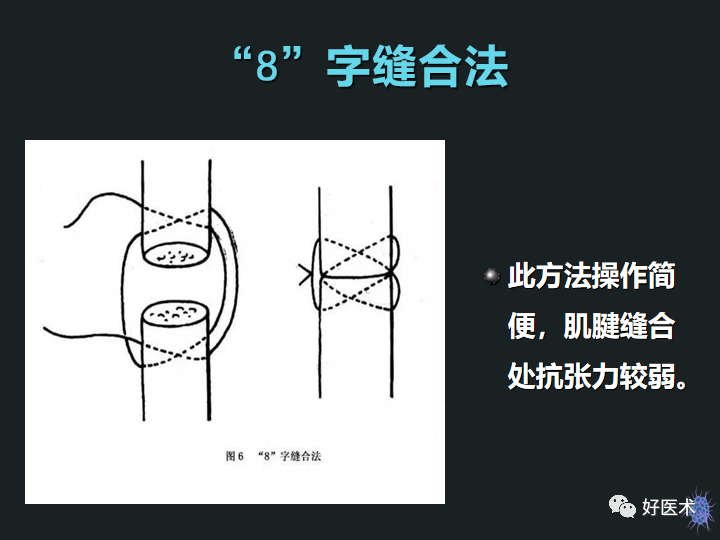 骨科必备技能肌腱缝合固定术，图文详解清晰明了！