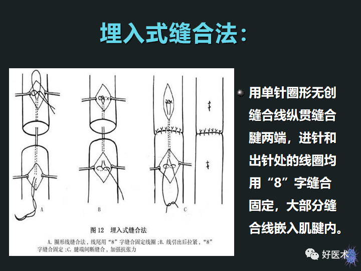 骨科必备技能肌腱缝合固定术，图文详解清晰明了！