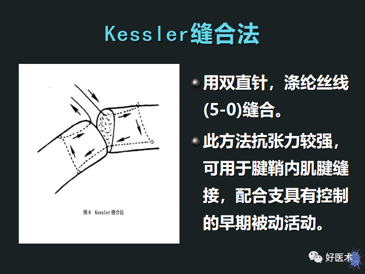 骨科必备技能肌腱缝合固定术，图文详解清晰明了！