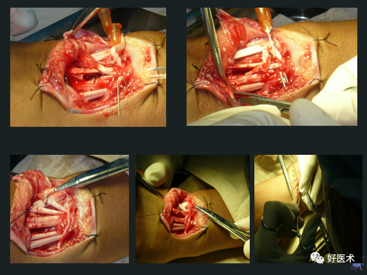 骨科必备技能肌腱缝合固定术，图文详解清晰明了！