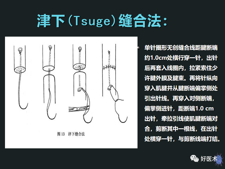 骨科必备技能肌腱缝合固定术，图文详解清晰明了！