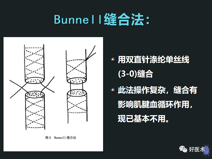 骨科必备技能肌腱缝合固定术，图文详解清晰明了！